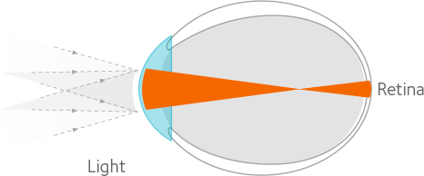 Myopic eye diagram