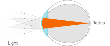 Non-myopic eye diagram