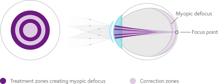 How MiSight 1 day contact lenses work